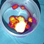 glowing brain tumor